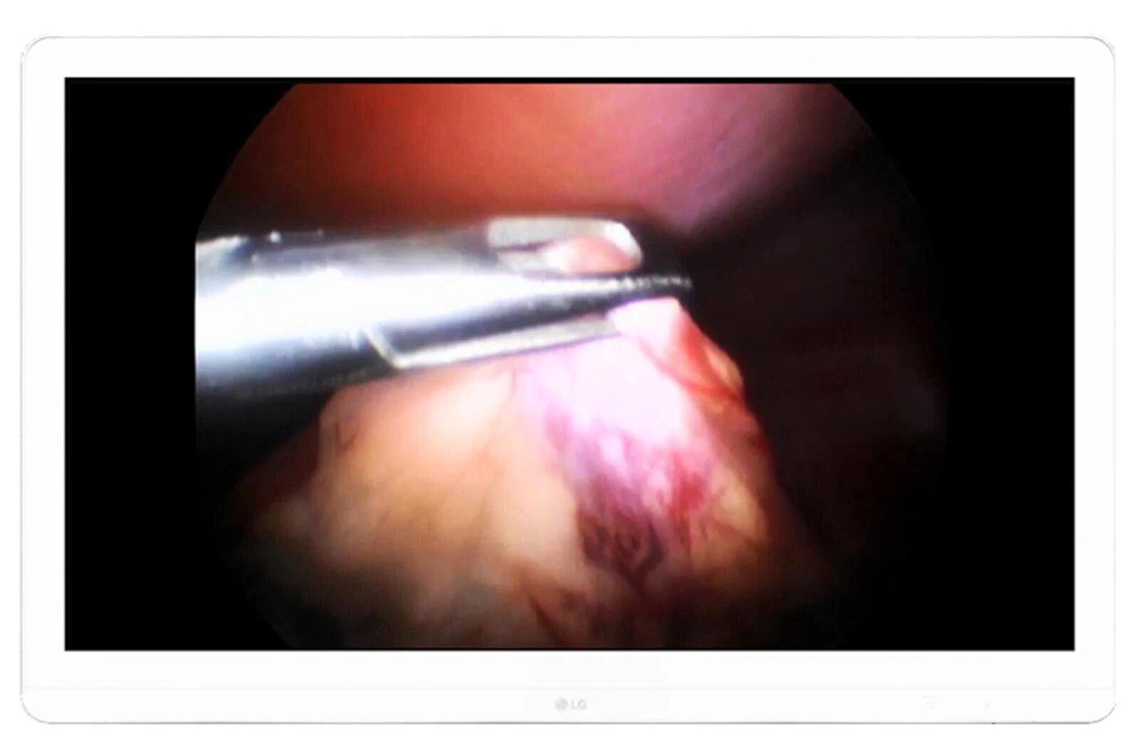 Monitor Quirúrgico 27"